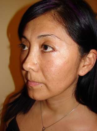 Blepharoplasty Before & After Patient #443