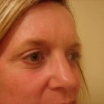 Blepharoplasty Before & After Patient #446