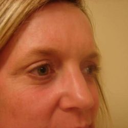 Blepharoplasty Before & After Patient #446