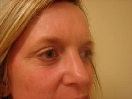 Blepharoplasty Before & After Patient #446