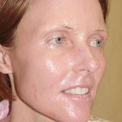 Laser Resurfacing Before & After Patient #152