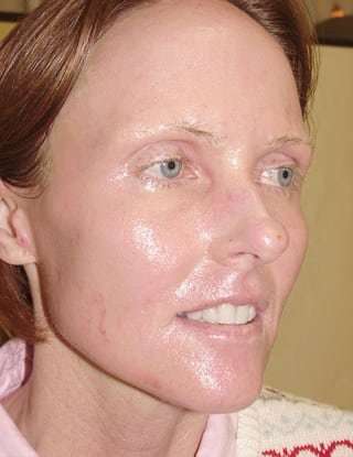 Laser Resurfacing Before & After Patient #152