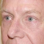 Blepharoplasty Before & After Patient #449