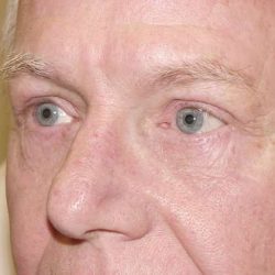 Blepharoplasty Before & After Patient #449