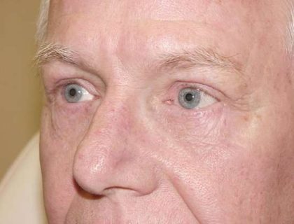 Blepharoplasty Before & After Patient #449