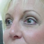 Blepharoplasty Before & After Patient #452