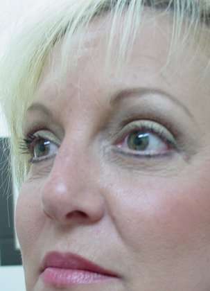 Blepharoplasty Before & After Patient #452