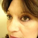 Blepharoplasty Before & After Patient #455