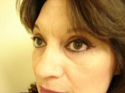 Blepharoplasty Before & After Patient #455