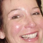 Blepharoplasty Before & After Patient #458