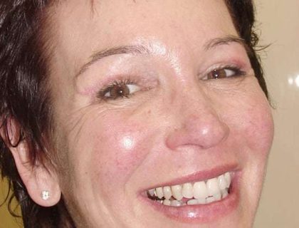 Blepharoplasty Before & After Patient #458