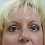 Blepharoplasty Before & After Patient #461