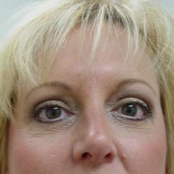 Blepharoplasty Before & After Patient #461