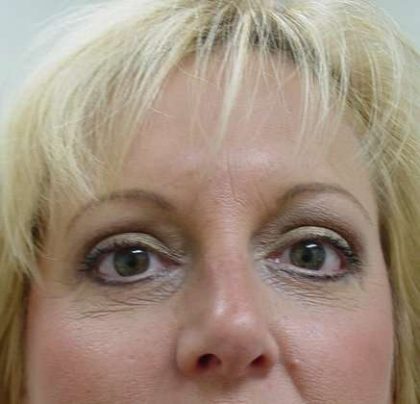 Blepharoplasty Before & After Patient #461