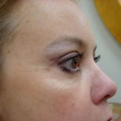 Blepharoplasty Before & After Patient #464