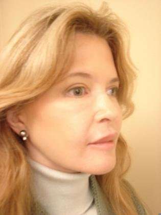 Blepharoplasty Before & After Patient #467