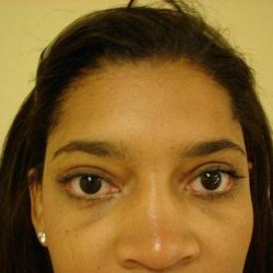 Blepharoplasty Before & After Patient #473