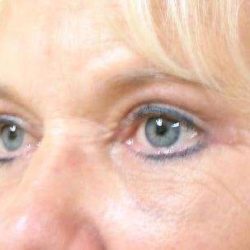 Blepharoplasty Before & After Patient #476