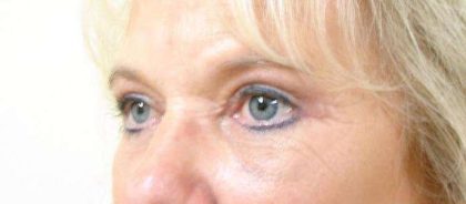 Blepharoplasty Before & After Patient #476