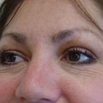 Blepharoplasty Before & After Patient #479