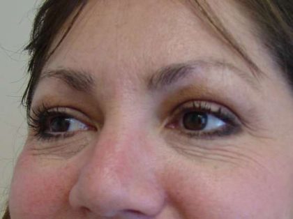 Blepharoplasty Before & After Patient #479