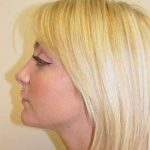Rhinoplasty Before & After Patient #241