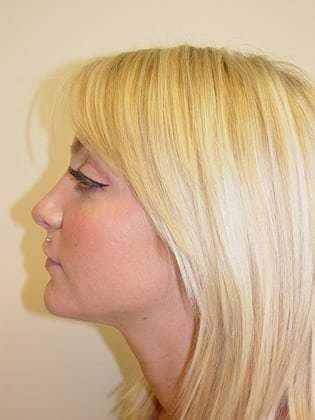 Rhinoplasty Before & After Patient #241