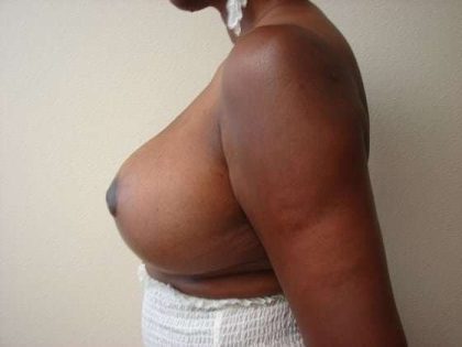 Breast Reduction Before & After Patient #519