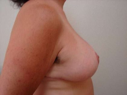 Breast Reduction Before & After Patient #532