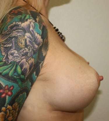 Breast Lift Before & After Patient #555