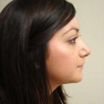Rhinoplasty Before & After Patient #230