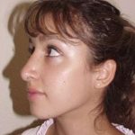 Rhinoplasty Before & After Patient #246