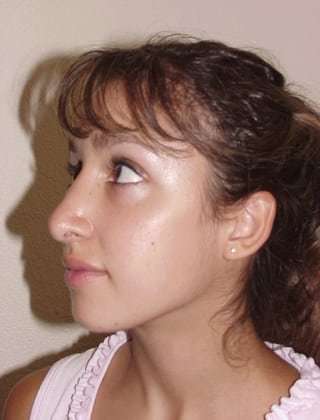 Rhinoplasty Before & After Patient #246