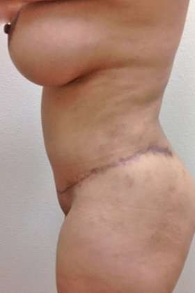 Mommy Makeover Before & After Patient #951