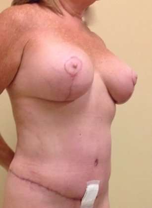 Mommy Makeover Before & After Patient #956