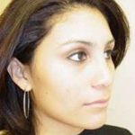 Rhinoplasty Before & After Patient #263