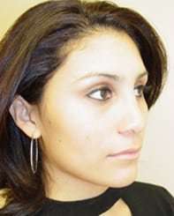Rhinoplasty Before & After Patient #263