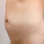 Liposuction Before & After Patient #988
