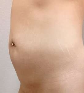 Liposuction Before & After Patient #988