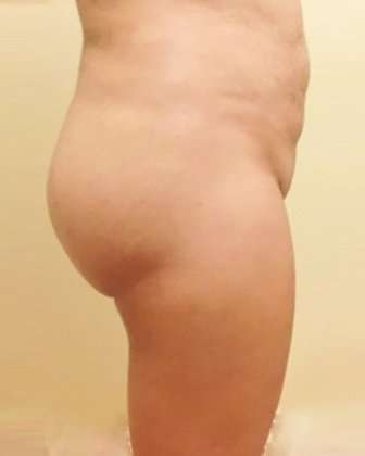 Brazilian Butt Lift Before & After Patient #1019