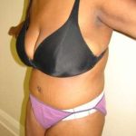 Abdominoplasty Before & After Patient #1098