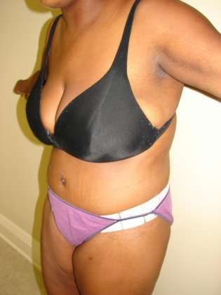 Abdominoplasty Before & After Patient #1098