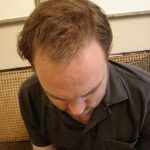 Hair Transplants Before & After Patient #328