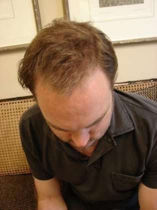 Hair Transplants Before & After Patient #328