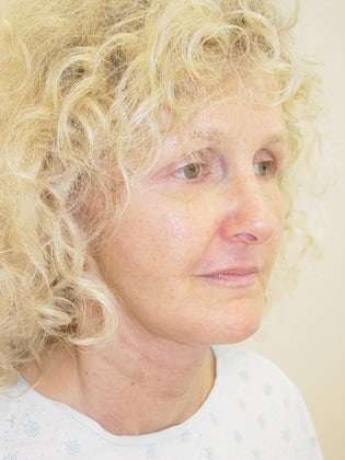 Facelift Before & After Patient #358