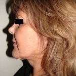Facelift Before & After Patient #384