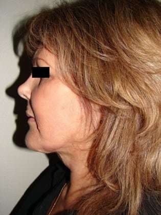 Facelift Before & After Patient #384