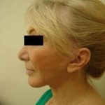 Facelift Before & After Patient #416