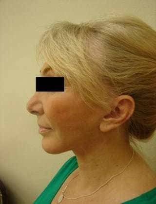 Facelift Before & After Patient #416