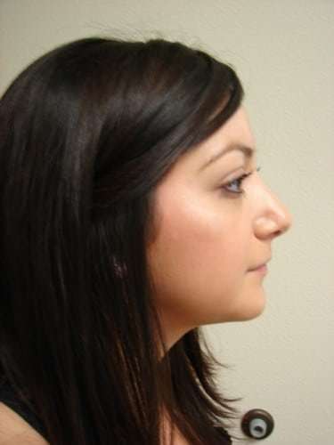 Rhinoplasty Before & After Patient #230